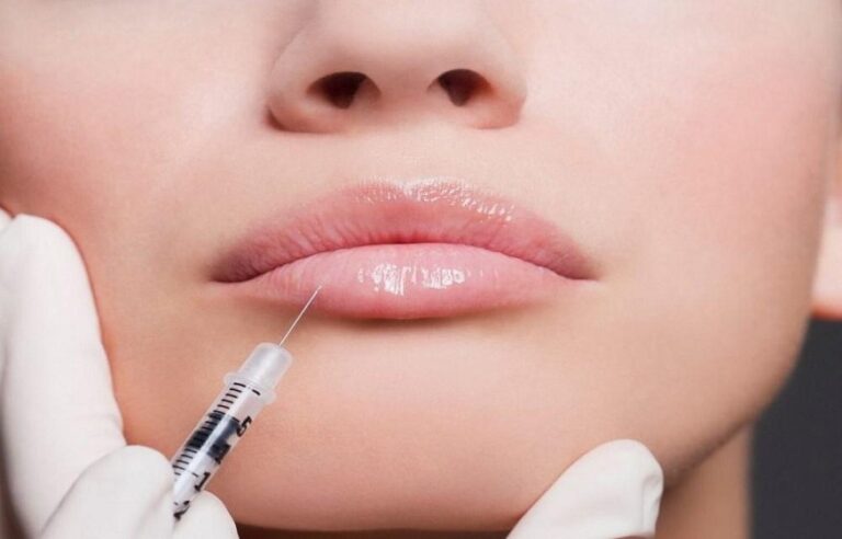 Why London Is A Haven For Lip Fillers
