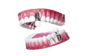 dental implants Singapore